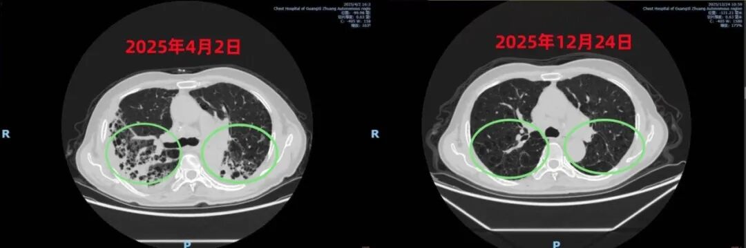 什么叫呼吸机依赖【健康在胸】从依赖呼吸机→自主呼吸，持续11日的生命拉锯战告捷_https://www.jmylbn.com_新闻资讯_第10张