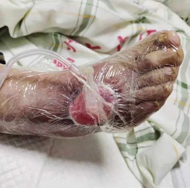 为什么负压引流让慢性伤口更快康复的好办法~_https://www.jmylbn.com_新闻资讯_第7张