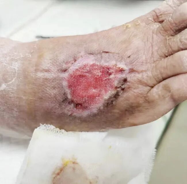 为什么负压引流让慢性伤口更快康复的好办法~_https://www.jmylbn.com_新闻资讯_第8张