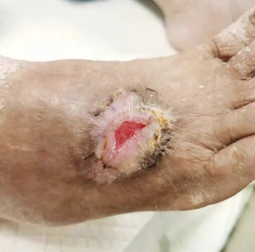 为什么负压引流让慢性伤口更快康复的好办法~_https://www.jmylbn.com_新闻资讯_第9张