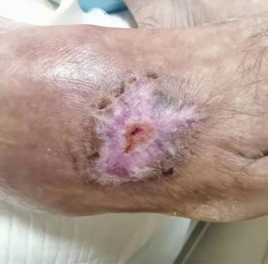 为什么负压引流让慢性伤口更快康复的好办法~_https://www.jmylbn.com_新闻资讯_第11张