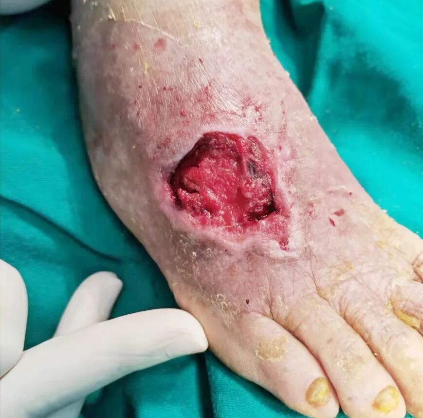 为什么负压引流让慢性伤口更快康复的好办法~_https://www.jmylbn.com_新闻资讯_第6张