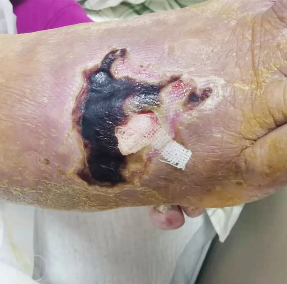 为什么负压引流让慢性伤口更快康复的好办法~_https://www.jmylbn.com_新闻资讯_第5张