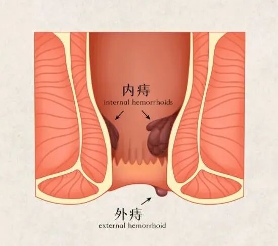 痔疮不好惹老年人更要防