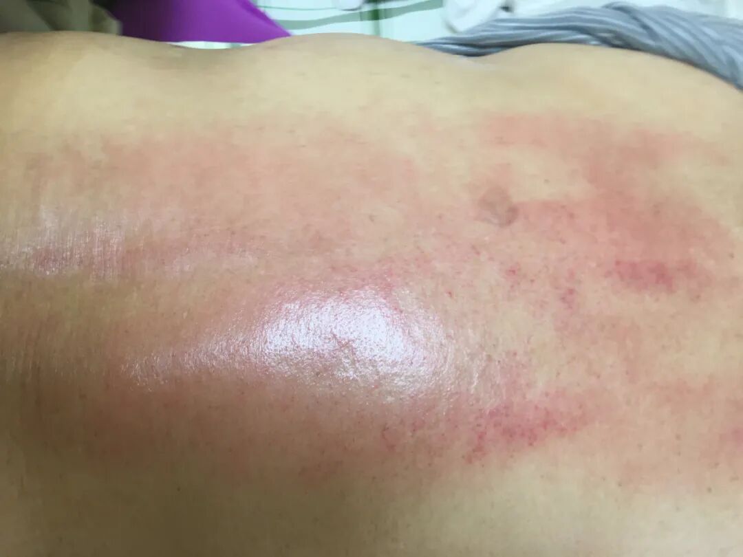 肺癌的阿姨咳嗽不止我们用刮痧来缓解