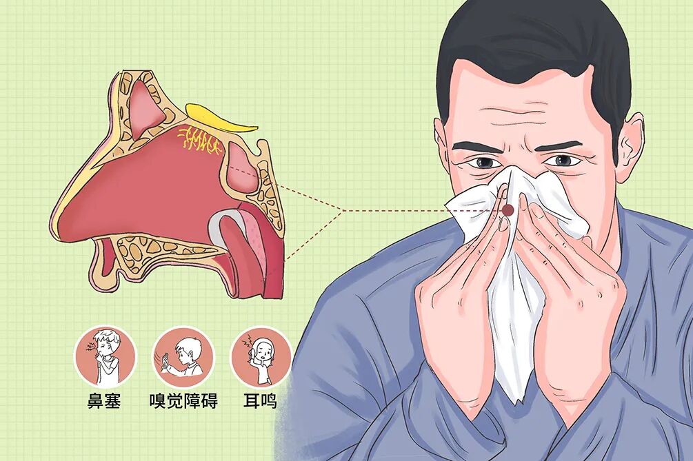 鼻息肉是块什么肉？