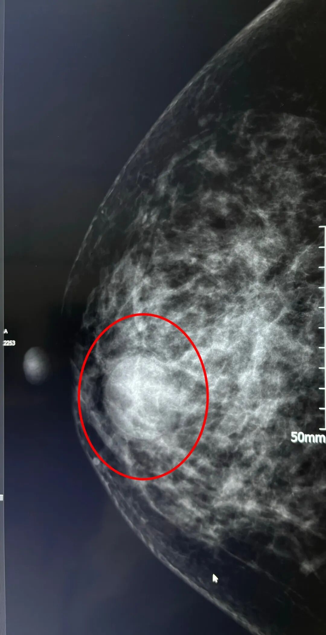 右乳断层是什么【健康科普】重塑乳腺健康视界：DBT技术引领精准诊断新时代-上海聚慕医疗器械有限公司