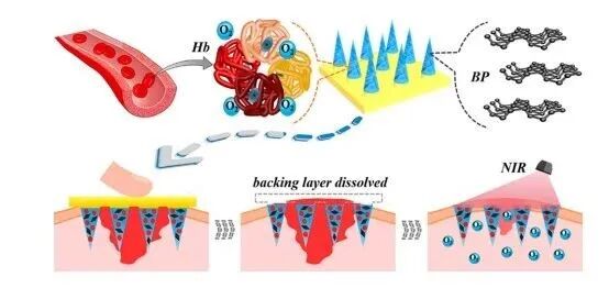 水凝胶伤口敷料怎么用【专题集锦】组织粘附与伤口敷料（20210803更新）_https://www.jmylbn.com_新闻资讯_第48张
