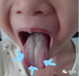 小孩反复发烧怎么办？小柴胡汤的使用攻略