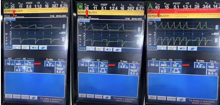 为什么呼吸机人机同步基层医院如何识别与处理「人机不同步」？为何说要防止为追求波形完美而调节呼吸机参数？_https://www.jmylbn.com_新闻资讯_第7张