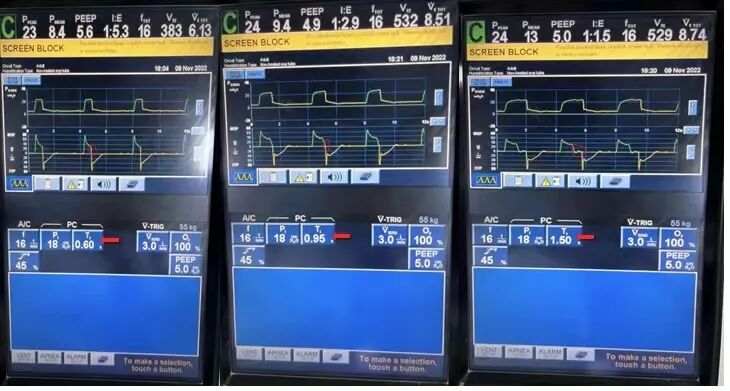 为什么呼吸机人机同步基层医院如何识别与处理「人机不同步」？为何说要防止为追求波形完美而调节呼吸机参数？_https://www.jmylbn.com_新闻资讯_第8张
