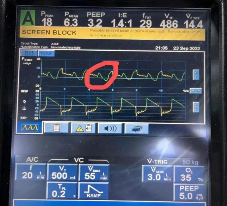为什么呼吸机人机同步基层医院如何识别与处理「人机不同步」？为何说要防止为追求波形完美而调节呼吸机参数？_https://www.jmylbn.com_新闻资讯_第5张