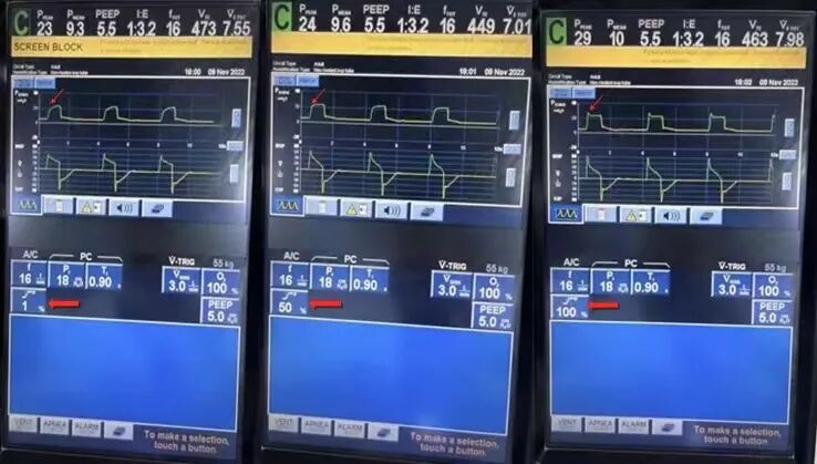 为什么呼吸机人机同步基层医院如何识别与处理「人机不同步」？为何说要防止为追求波形完美而调节呼吸机参数？_https://www.jmylbn.com_新闻资讯_第6张