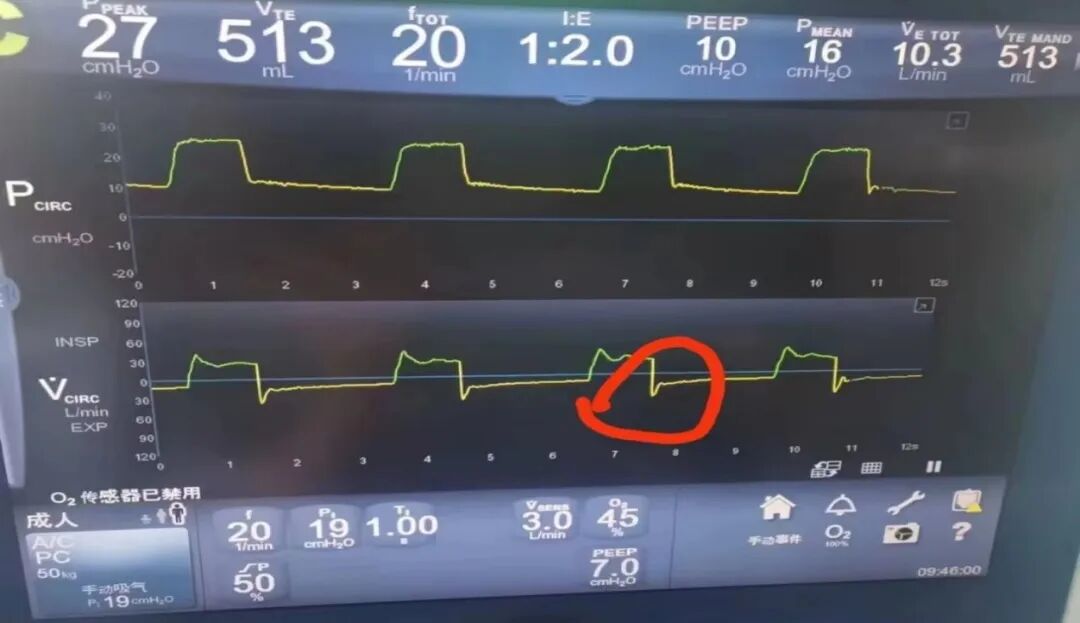为什么呼吸机人机同步基层医院如何识别与处理「人机不同步」？为何说要防止为追求波形完美而调节呼吸机参数？_https://www.jmylbn.com_新闻资讯_第10张