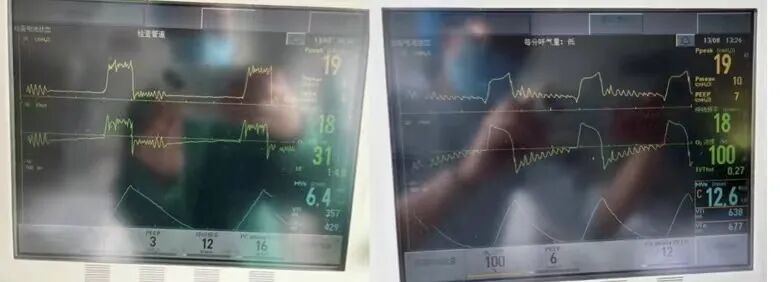 为什么呼吸机人机同步基层医院如何识别与处理「人机不同步」？为何说要防止为追求波形完美而调节呼吸机参数？_https://www.jmylbn.com_新闻资讯_第4张