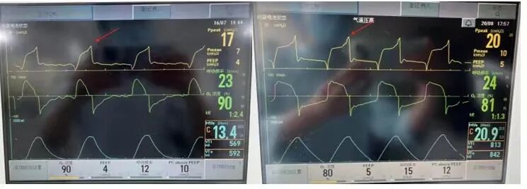 为什么呼吸机人机同步基层医院如何识别与处理「人机不同步」？为何说要防止为追求波形完美而调节呼吸机参数？_https://www.jmylbn.com_新闻资讯_第9张