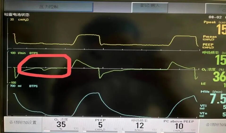 为什么呼吸机人机同步基层医院如何识别与处理「人机不同步」？为何说要防止为追求波形完美而调节呼吸机参数？_https://www.jmylbn.com_新闻资讯_第2张