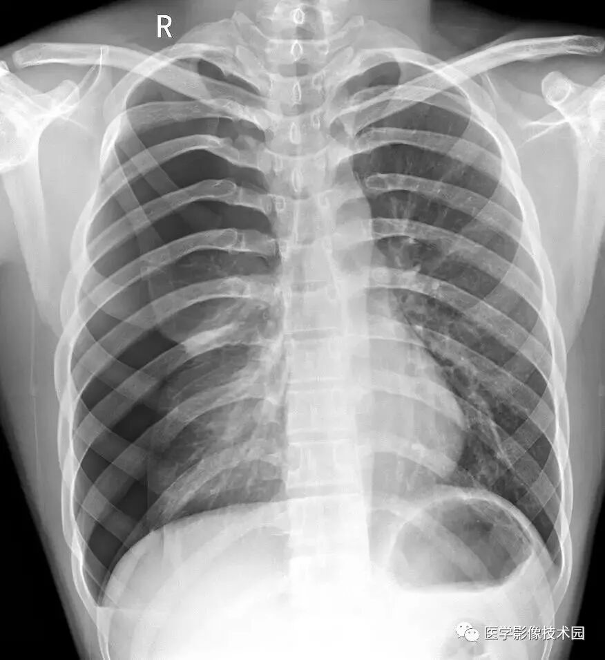 x线为什么锥形束影像学之X线检查--X线发现、X线产生、X线成像、X线特性_https://www.jmylbn.com_新闻资讯_第4张