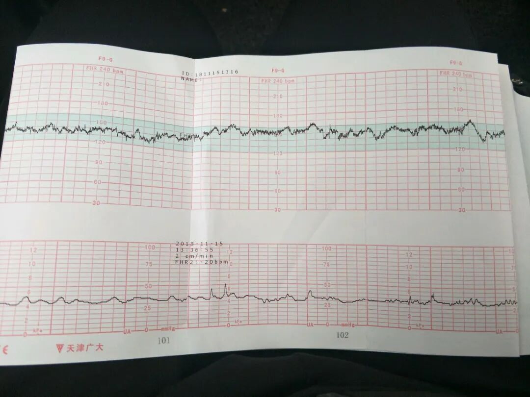 什么是胎儿监护仪胎心监护怎么看？_https://www.jmylbn.com_新闻资讯_第4张