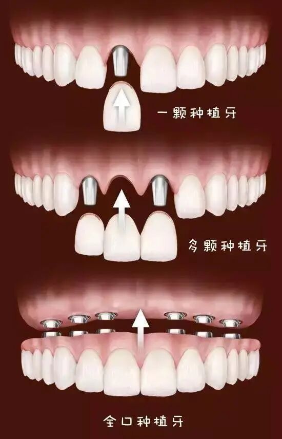 种植牙vs镶牙|哪个更胜一筹?