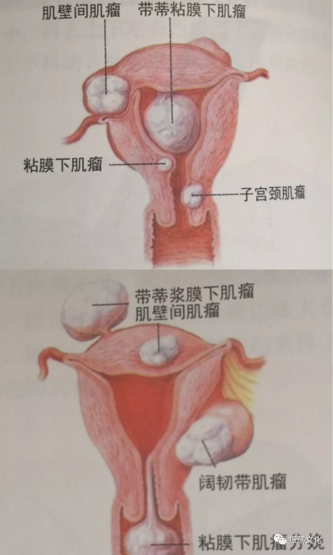 气血疏通vs子宫肌瘤 专业治疗篇 液针刀骨伤医学研究院 微信公众号文章阅读 Wemp