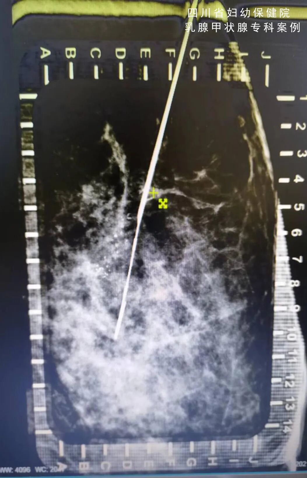 怎么制造手术钩针看医生如何精准“钩出”乳腺钙化灶，将早期乳腺癌“绳之以法”_https://www.jmylbn.com_新闻资讯_第4张