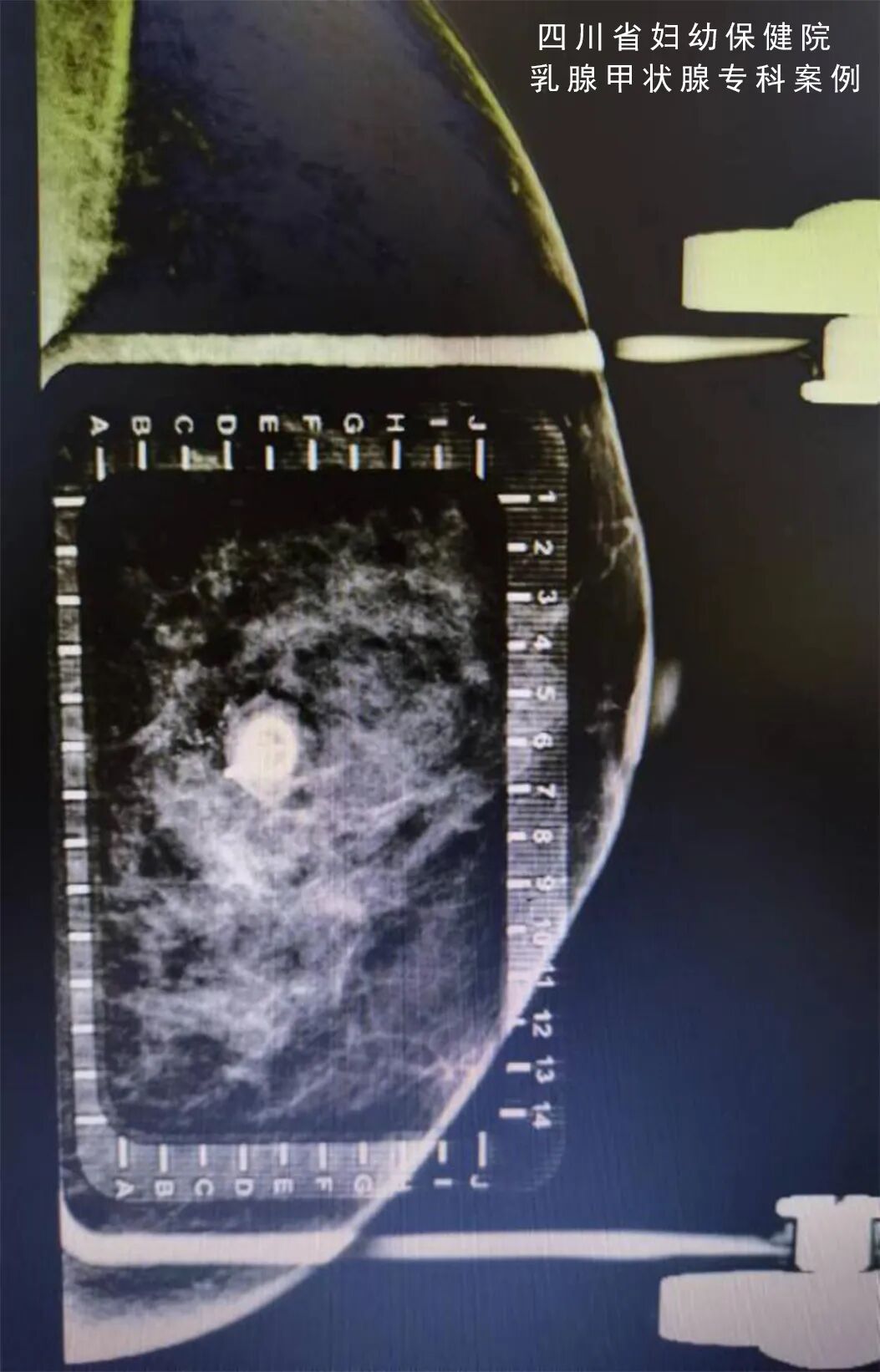 怎么制造手术钩针看医生如何精准“钩出”乳腺钙化灶，将早期乳腺癌“绳之以法”_https://www.jmylbn.com_新闻资讯_第3张