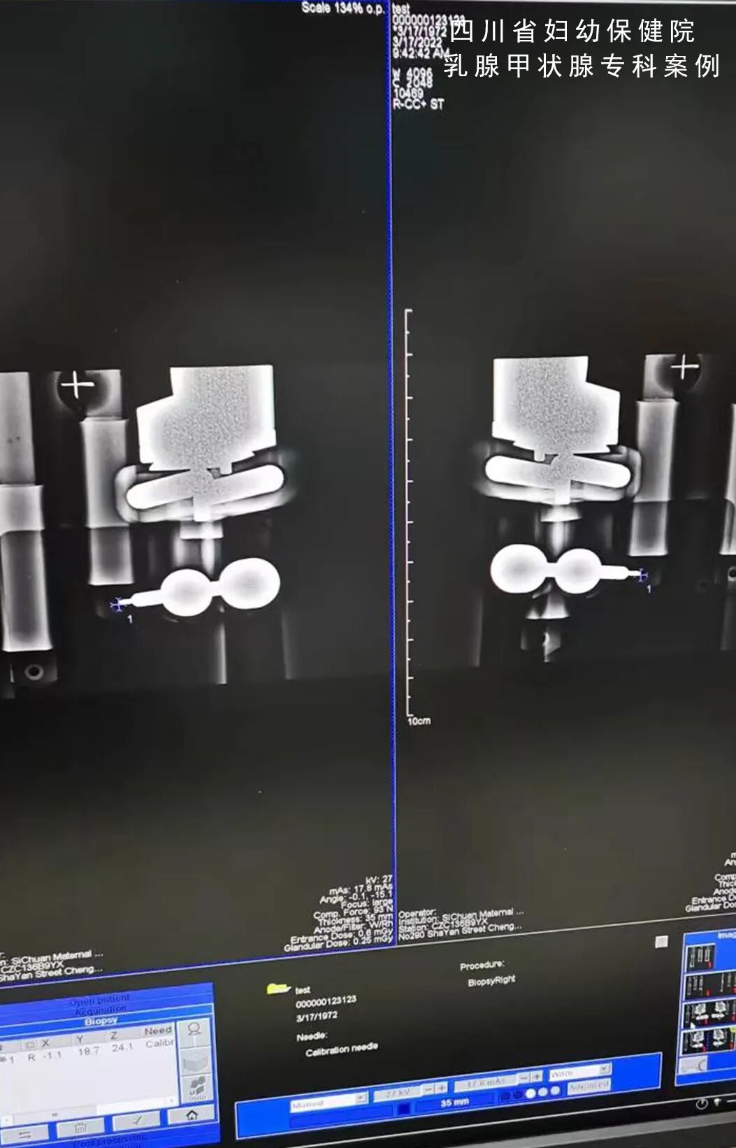 怎么制造手术钩针看医生如何精准“钩出”乳腺钙化灶，将早期乳腺癌“绳之以法”_https://www.jmylbn.com_新闻资讯_第7张