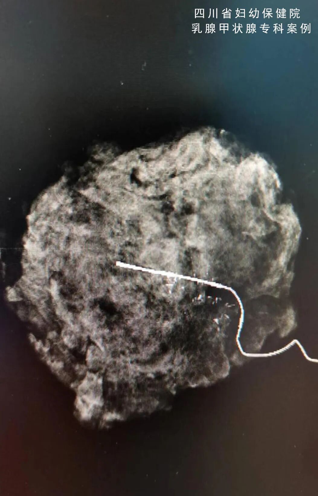 怎么制造手术钩针看医生如何精准“钩出”乳腺钙化灶，将早期乳腺癌“绳之以法”_https://www.jmylbn.com_新闻资讯_第5张