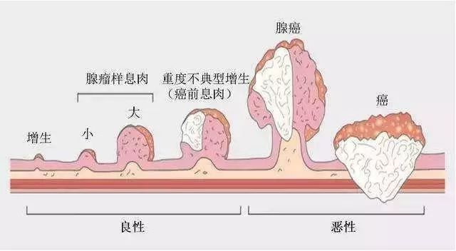 咱們來分析一下這個病例除了此處癌腫之外,還在乙狀結腸,橫結腸發現數