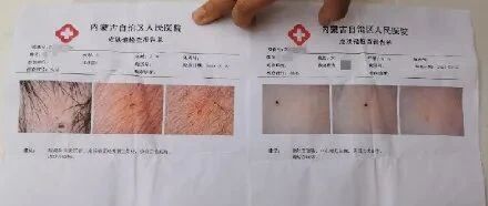 幼儿园多名孩子身上有不明针眼！3人被刑拘！