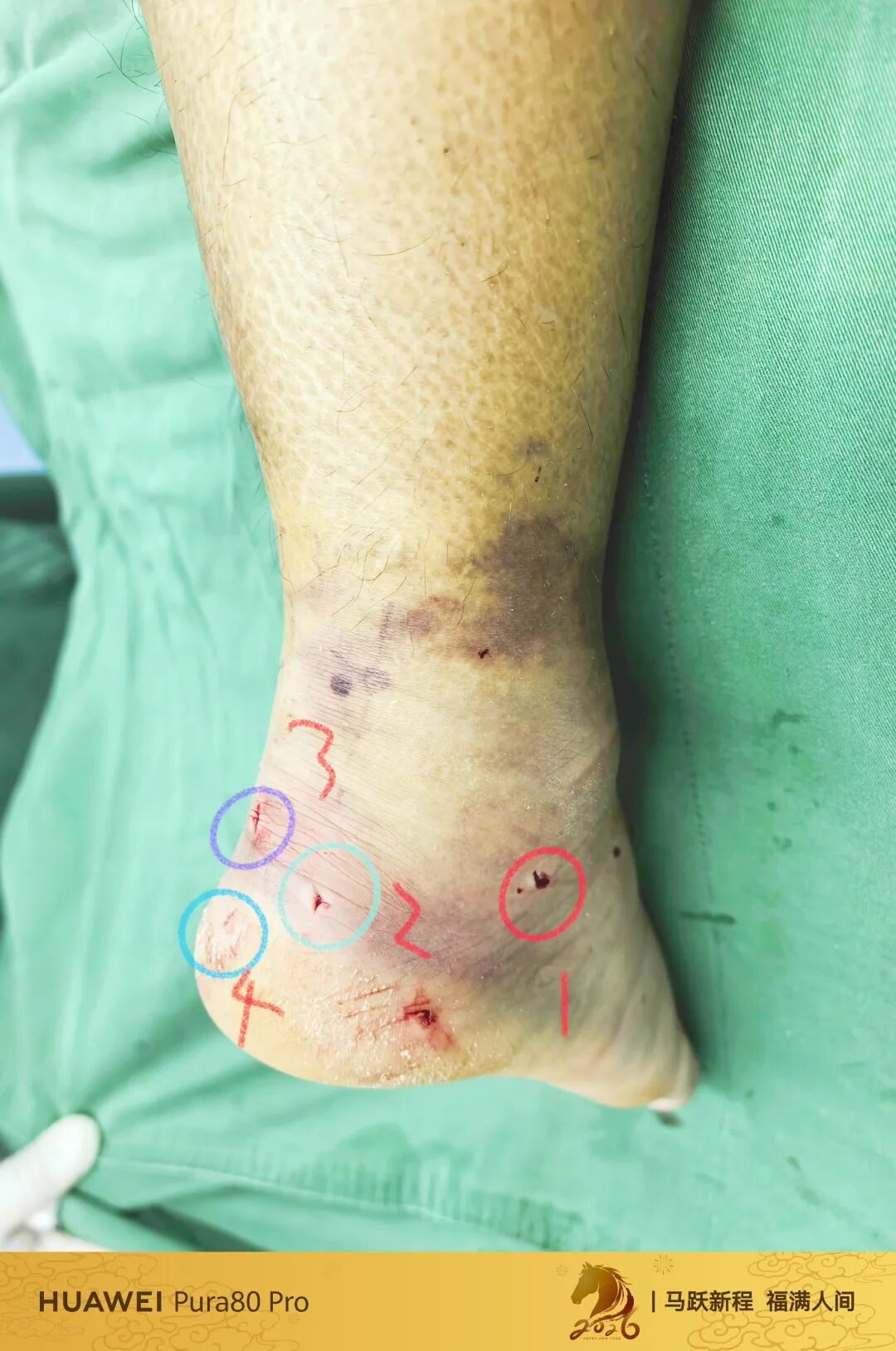 跟骨微创，无需等待消肿，无需担心切口感染、皮肤坏死