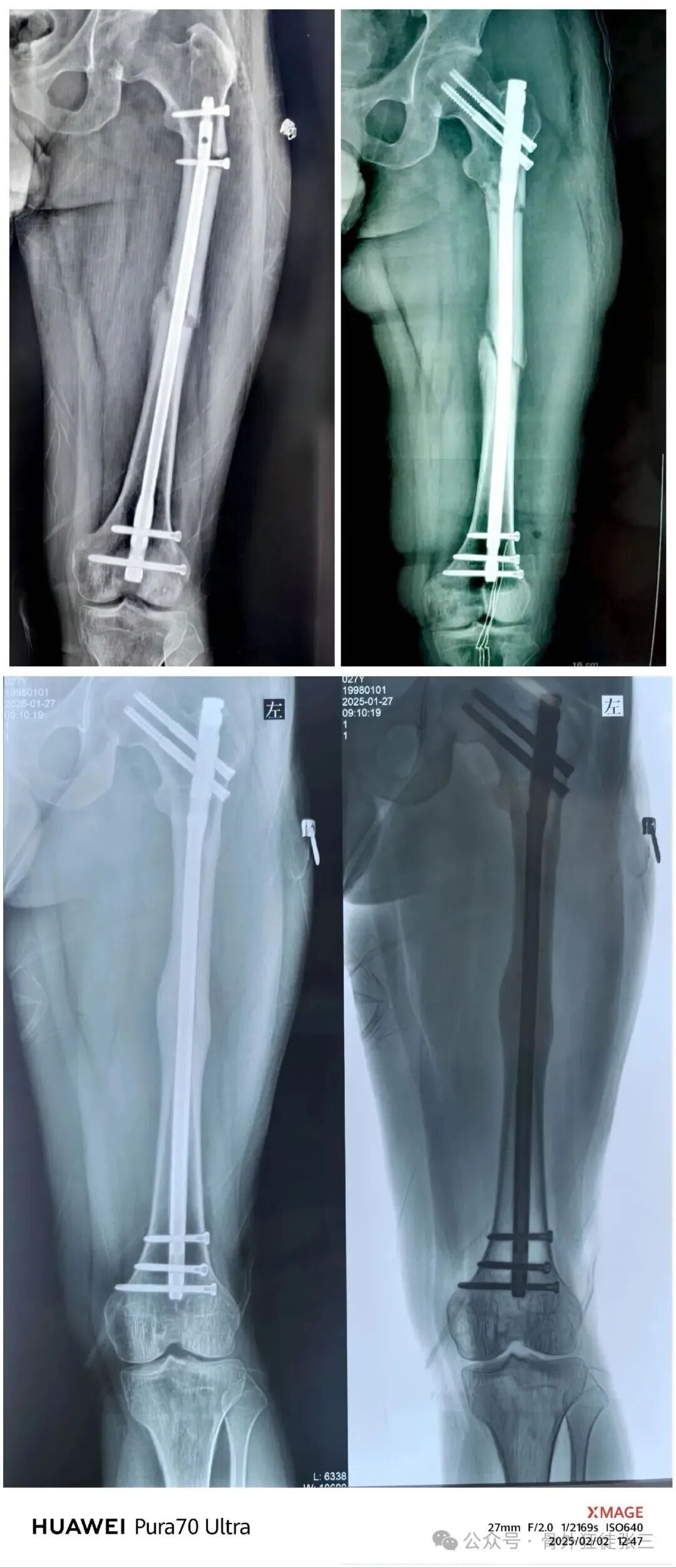 股骨干骨折为什么要“顶天立地”“能顺行不逆行”