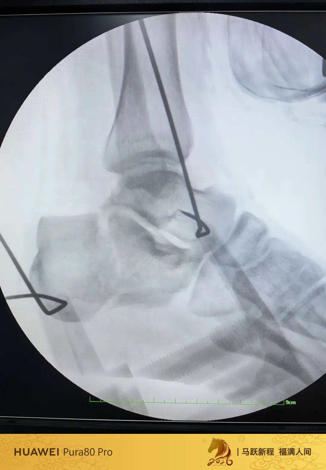 跟骨微创，无需等待消肿，无需担心切口感染、皮肤坏死