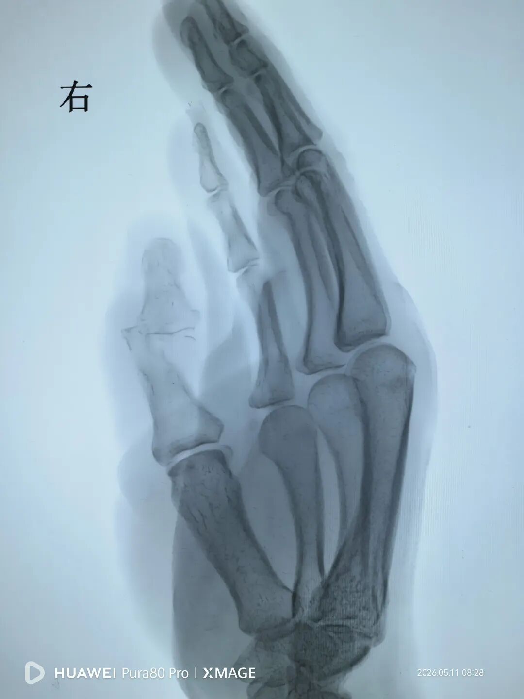 鱼刺扎伤后感染，慢性骨髓炎。