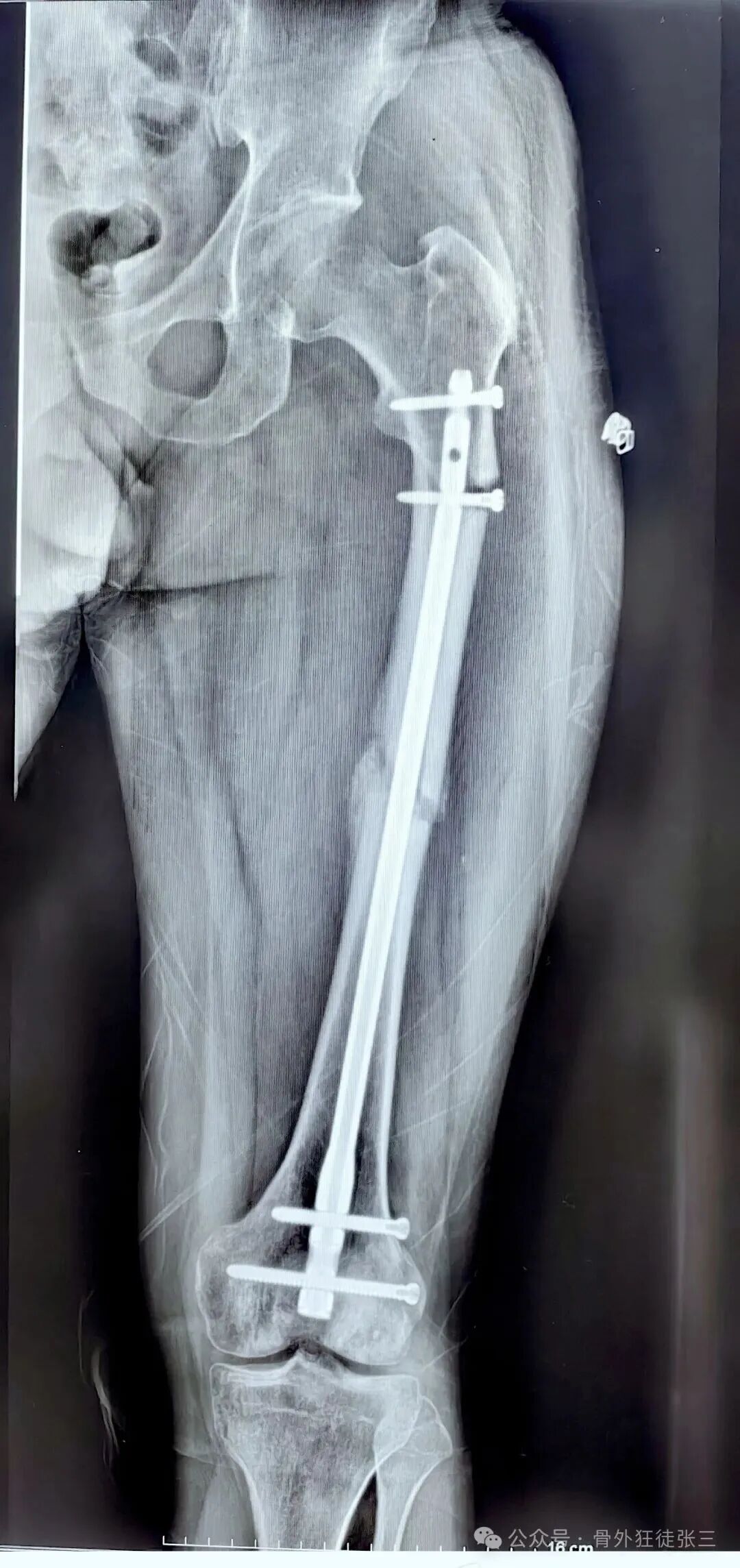 股骨干骨折为什么要“顶天立地”“能顺行不逆行”