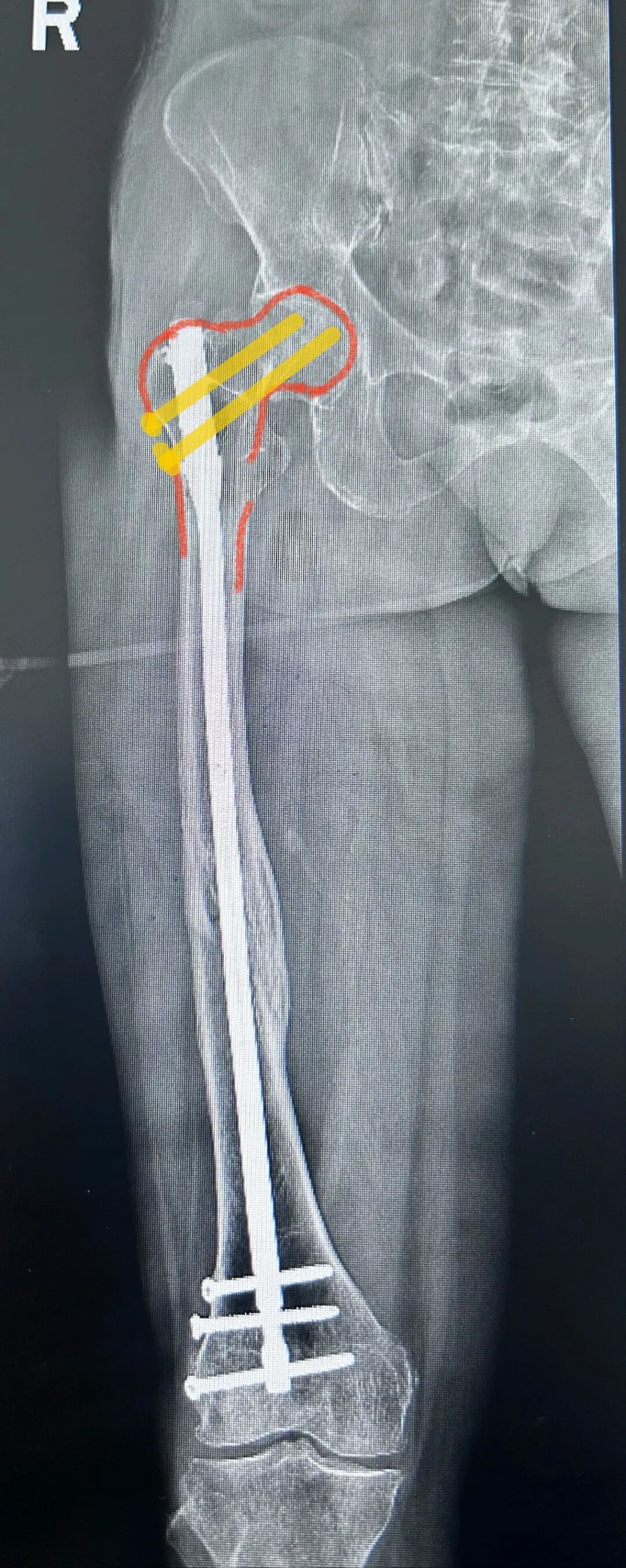 股骨干骨折为什么要“顶天立地”“能顺行不逆行”
