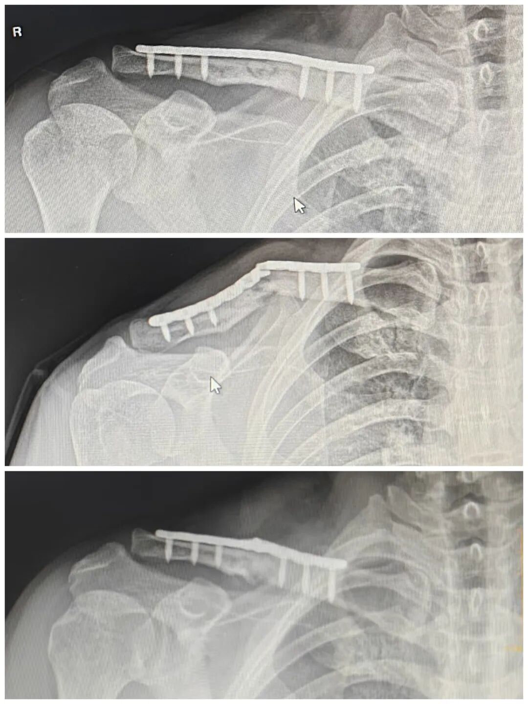无“为“而治：锁骨断板，必须手术翻修吗？