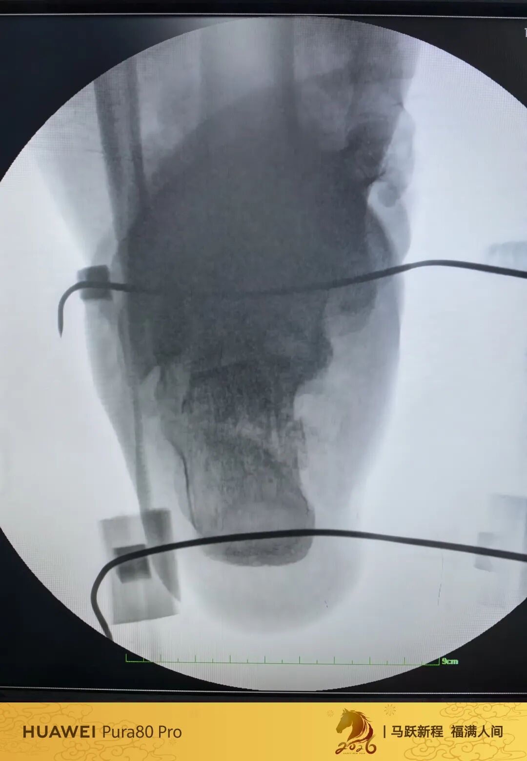 跟骨微创，无需等待消肿，无需担心切口感染、皮肤坏死