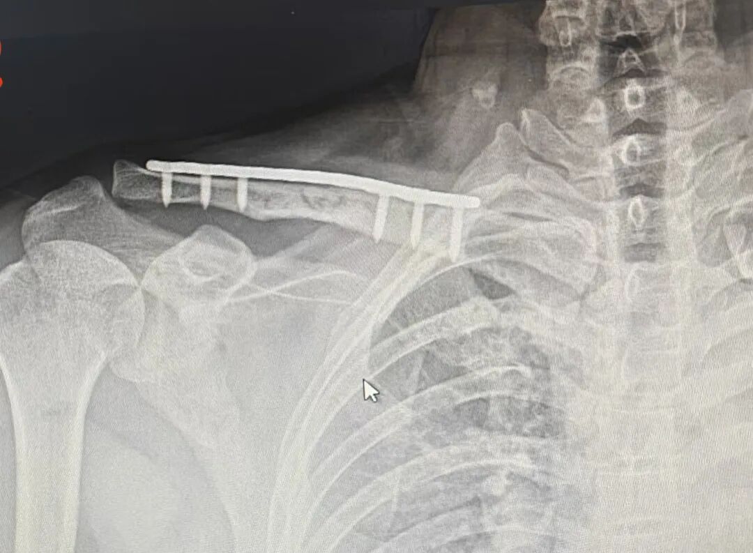 无“为“而治：锁骨断板，必须手术翻修吗？