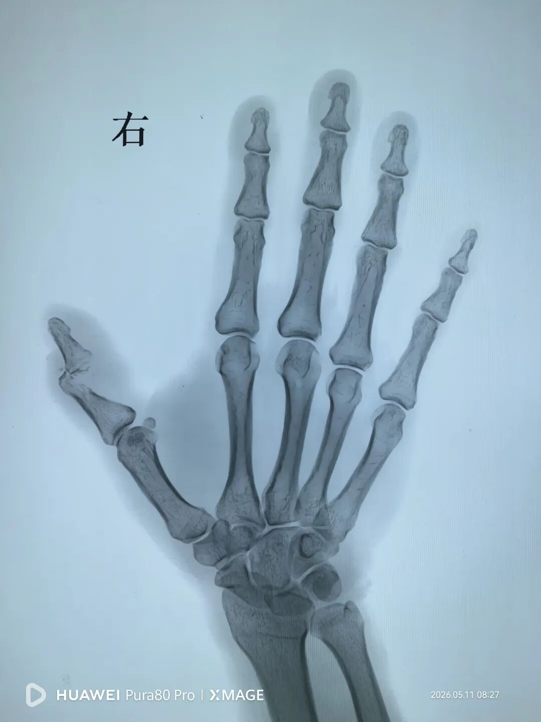 鱼刺扎伤后感染，慢性骨髓炎。