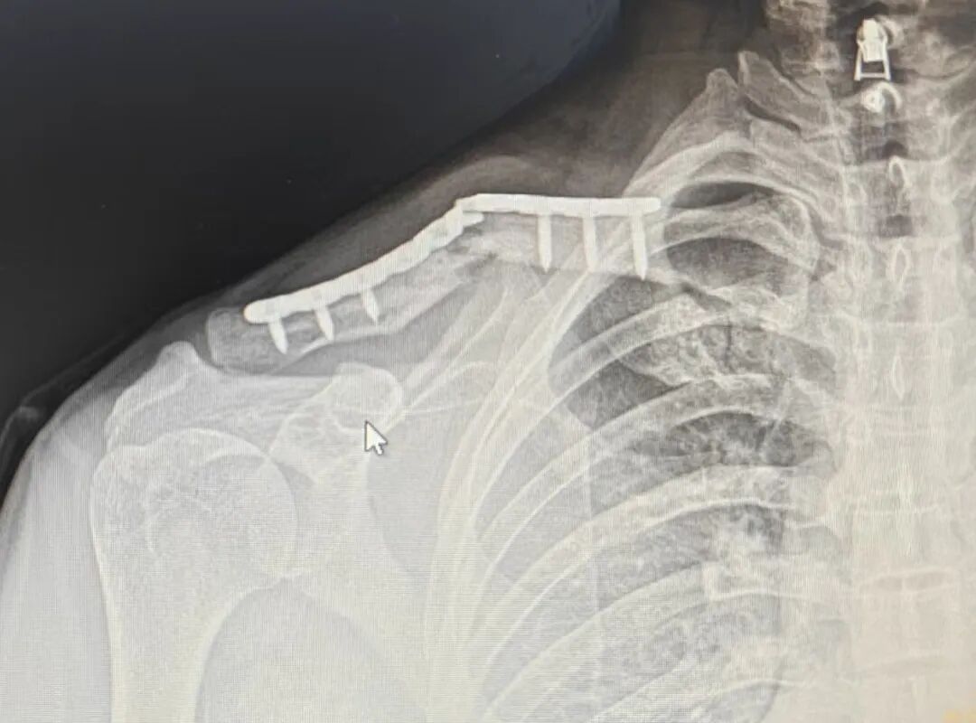 无“为“而治：锁骨断板，必须手术翻修吗？