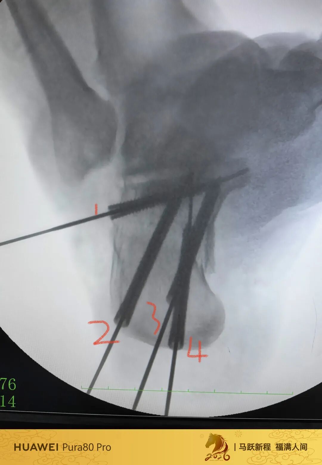 跟骨微创，无需等待消肿，无需担心切口感染、皮肤坏死