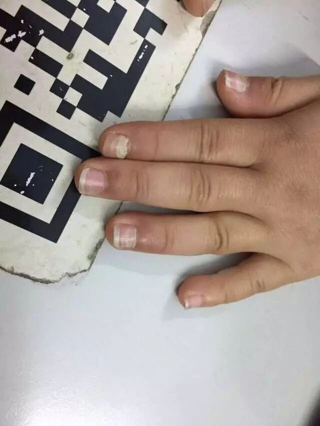 孩子指甲脱落是怎么回事详解脱甲症