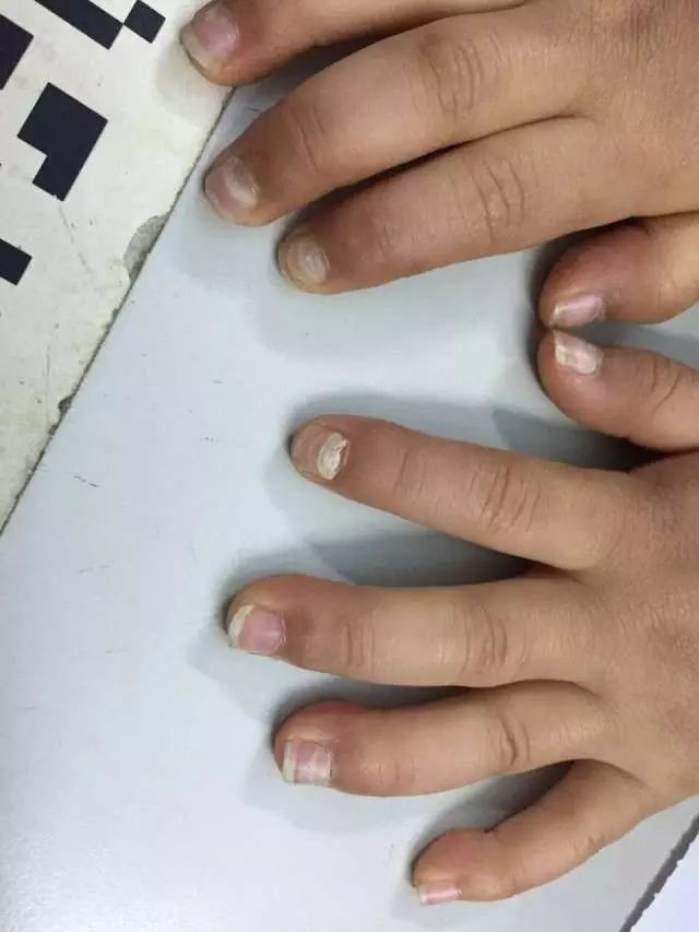 孩子指甲脱落是怎么回事详解脱甲症