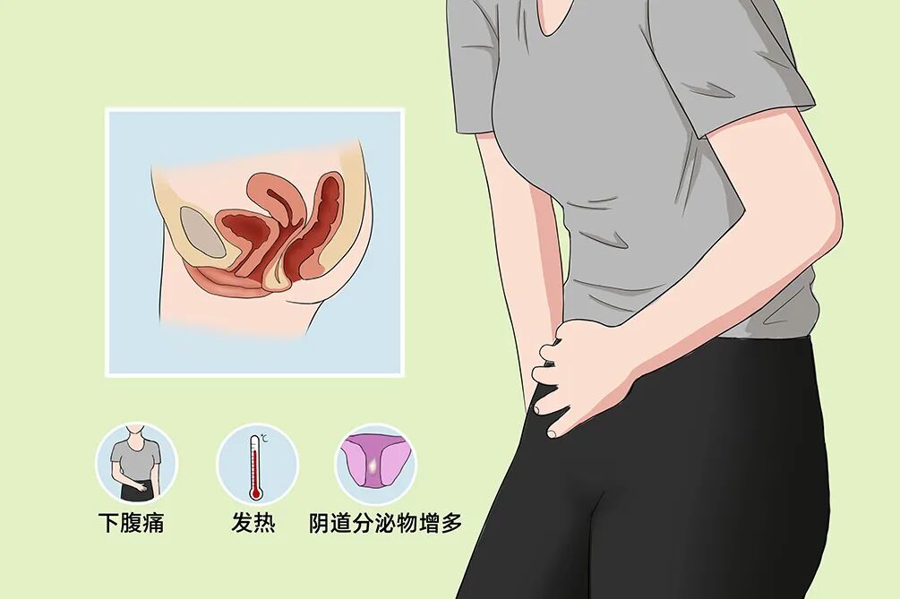 梁一堂对于盆腔炎千万不能拖