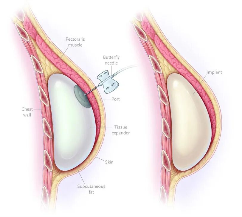 压力绷带为什么那么贵重建 ｜ 乳房重建选还是不选，你需要知道这些！_https://www.jmylbn.com_新闻资讯_第9张