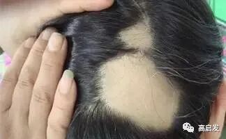 斑秃的防治