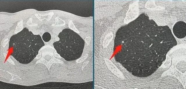 肺部小结节 肺部小结节