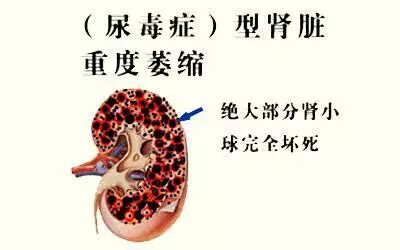 肾功能衰竭尿毒症与糖尿病有什么关系教你构筑3道防线狙击糖尿病肾病